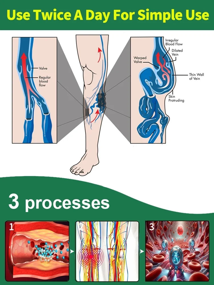 Generation-2 Laser Treatment – Reduces Spider & Varicose Veins in 7 Days, Non-Invasive Vein Care